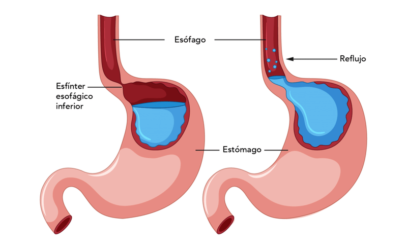 Dispepsia Funcional: Sintomatología y Tratamiento Nutricional