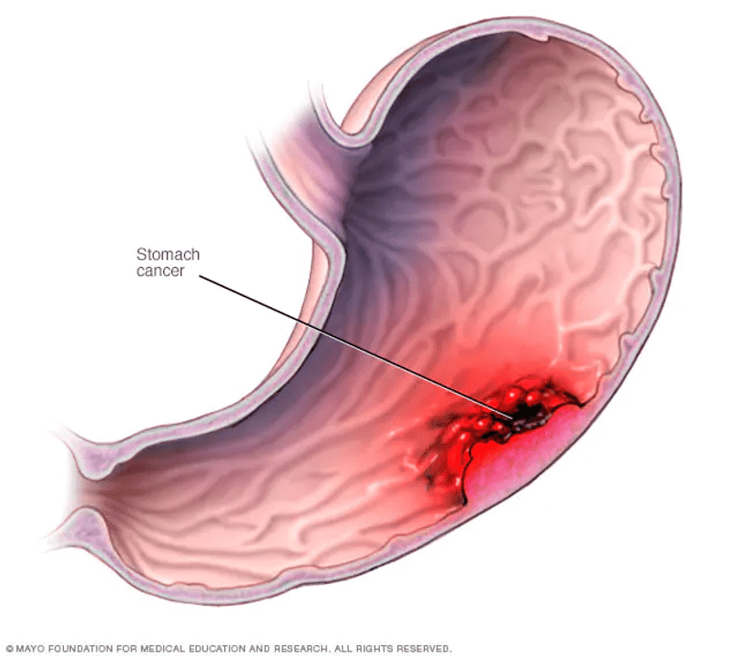 Carcinoma Gástrico: Factores de Riesgo y Tratamiento