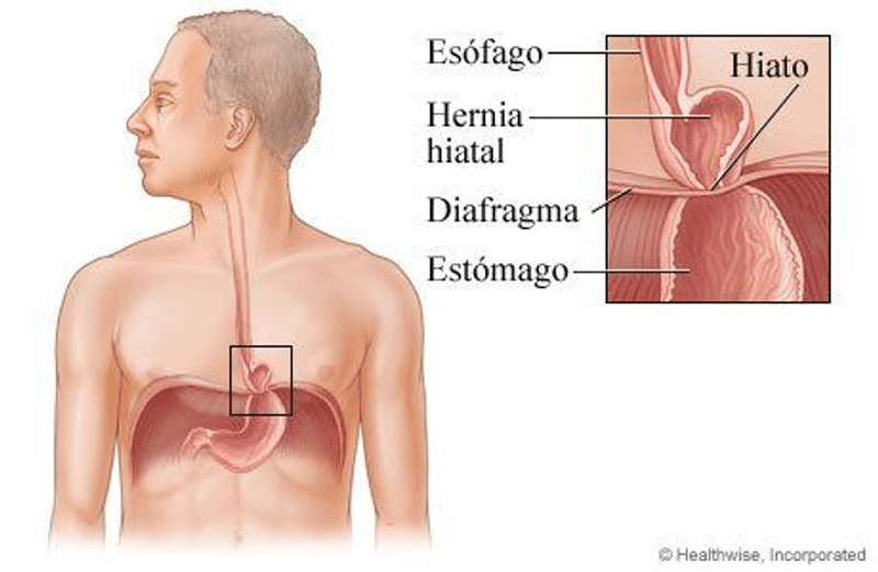 Hernia de Hiato: Definición, Sintomatología y Tratamiento