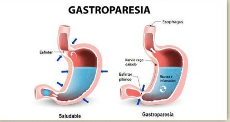 Gastroparesia: Causas, Síntomas y Tratamiento