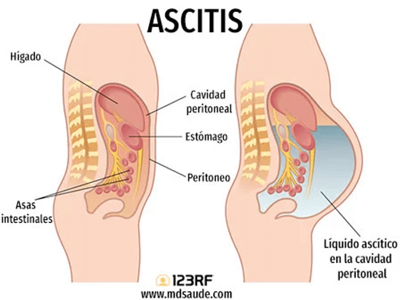 Ascitis: Definición y Tratamiento