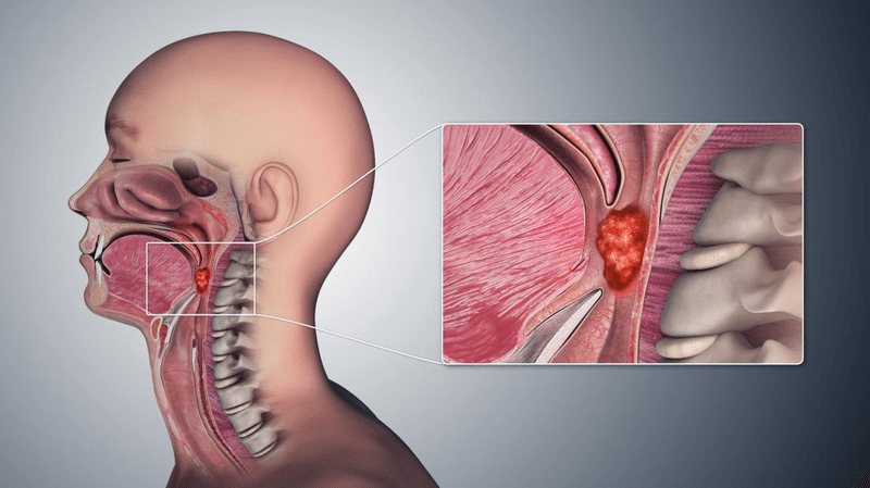 Cáncer de Garganta: Sintomatología, Factores de riesgo y Tratamiento