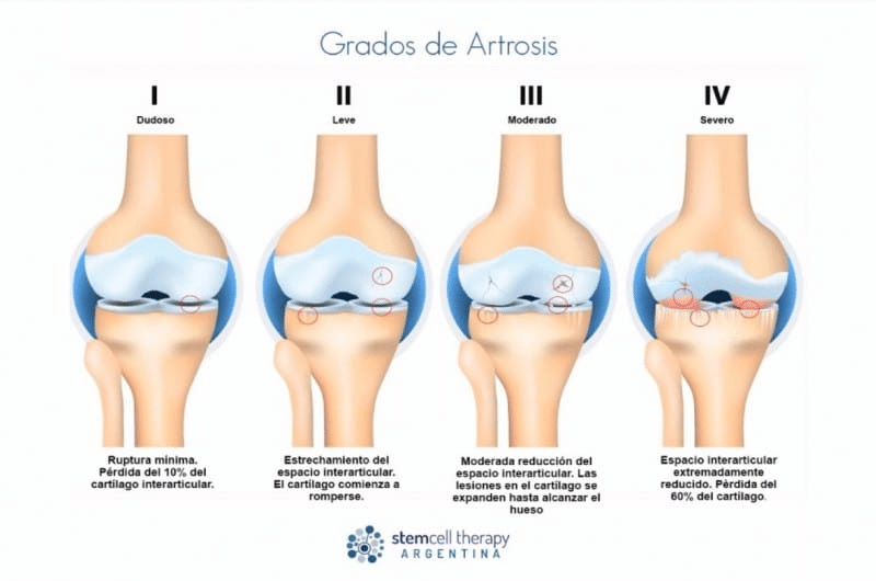 Artrosis: Definición, Factores de riesgo y Tratamiento