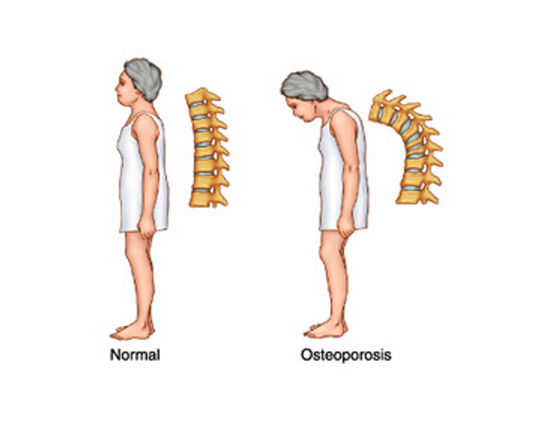 Osteoporosis: Sintomatología, diagnóstico y tratamiento