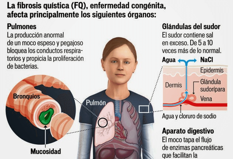 Fibrosis Quística: Definición y Tratamiento